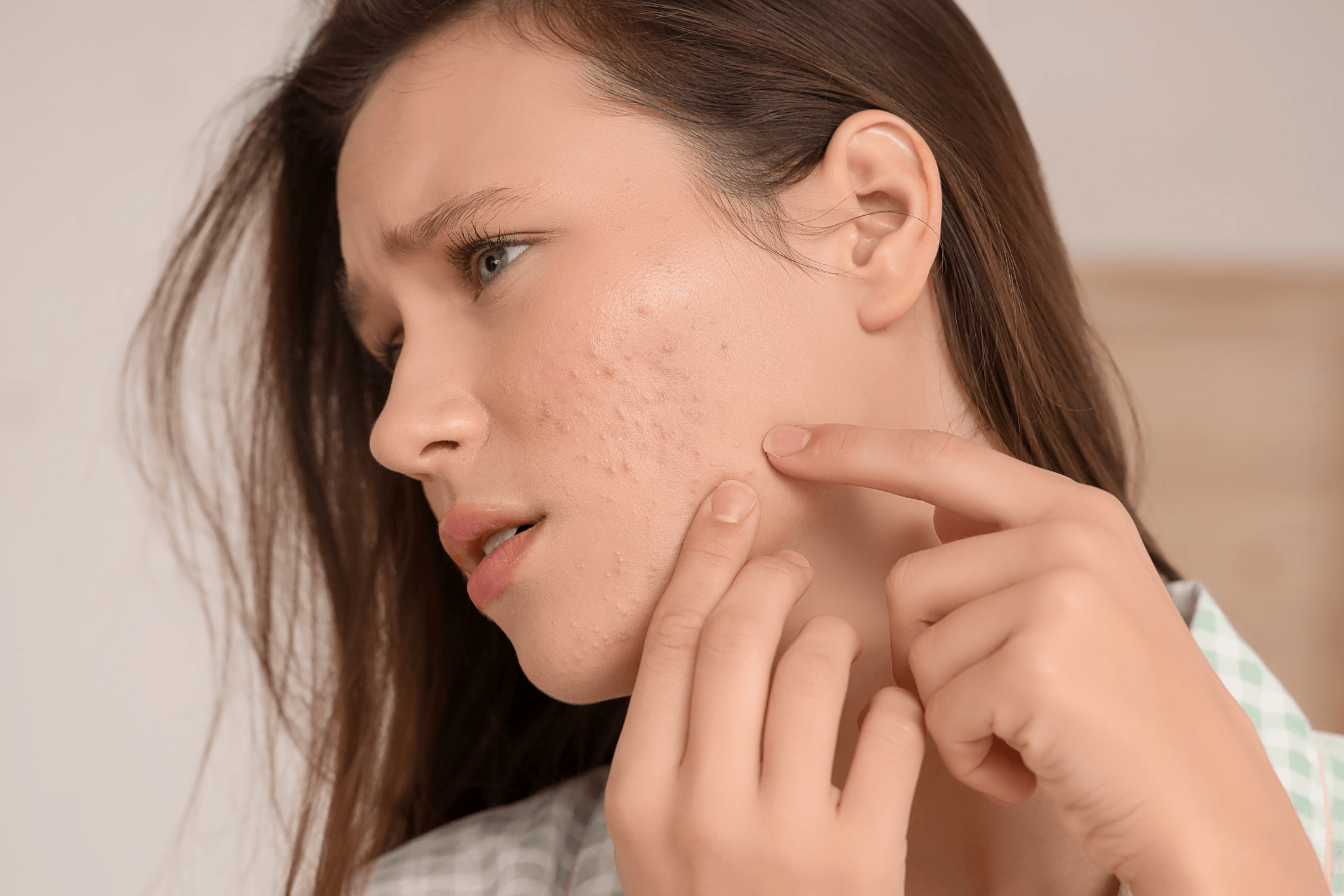 Acne Calming Facial at AQueen Spa